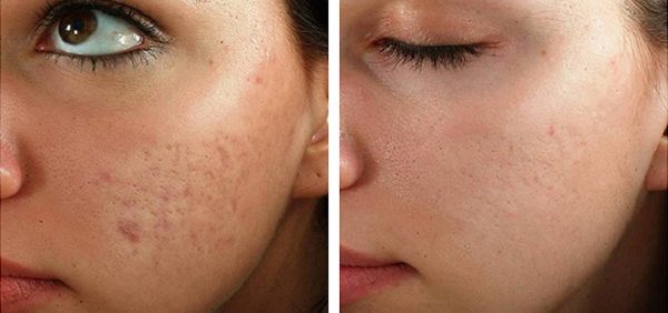 Cicatricure Dermoabrasivo antes e depois