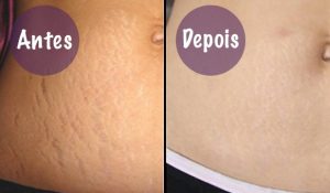 Cicatricure para Estrias: preço, como funciona e mais!