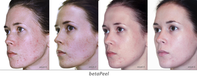 Peeling facial: como funciona, efeitos e mais!