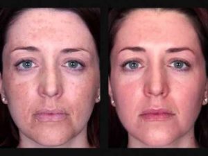 Peeling facial: como funciona, efeitos e mais!