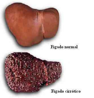 comparação do fígado - cirrose