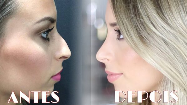 Rinoplastia: Antes E Depois, Como Funciona E Tudo Sobre Esse Procedimento