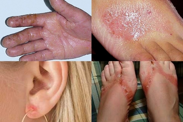Dermatite 