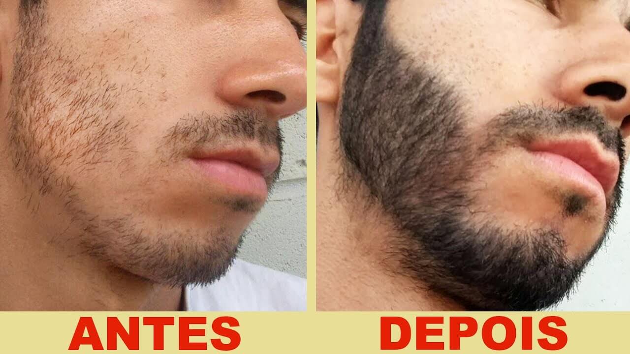 minoxidil barba