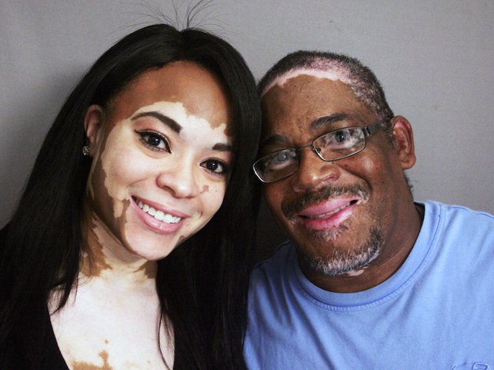 pomada para vitiligo