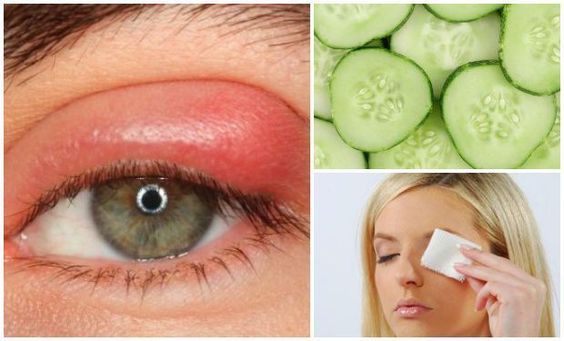 Terçol no Olho : o que? por que ocorre? como evitar e cuidar?