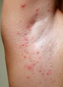 Alergia a depilação - sintomas e como evitar