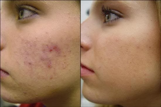 Como evitar e reduzir pele acneica