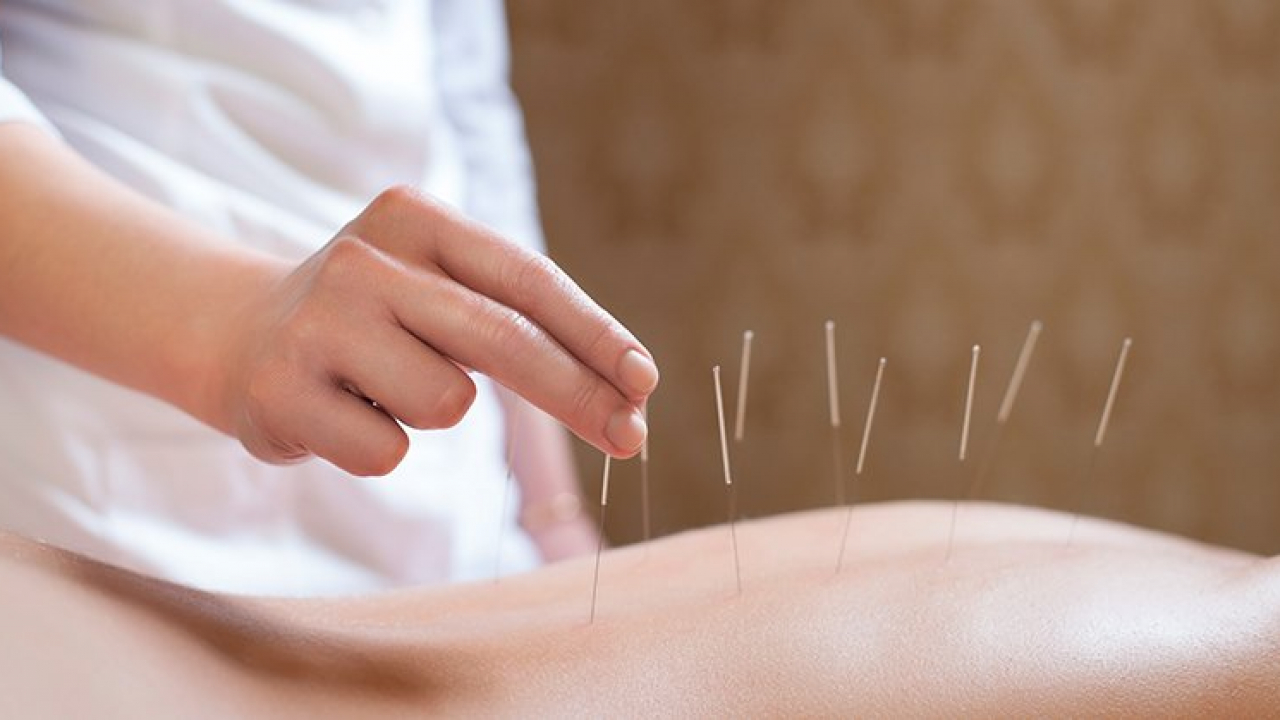 acupuntura beneficios