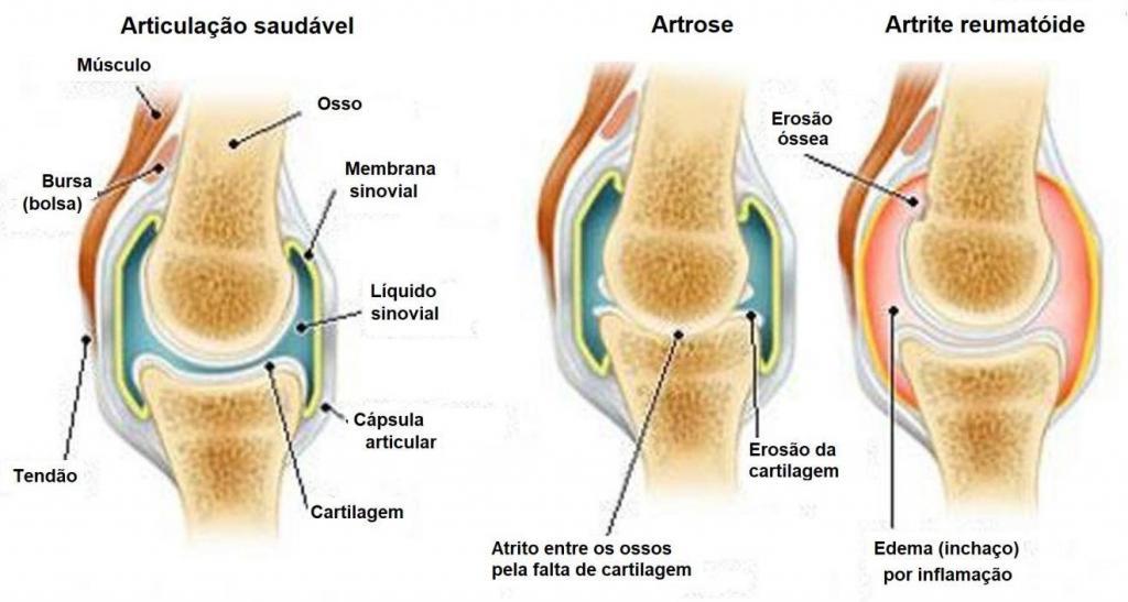 artrite infografico